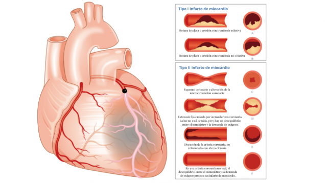 Infarto agudo de miocardio | Hospital Universitario 12 de Octubre